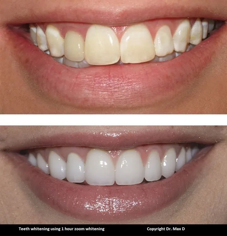 27553 tooth discoloration
